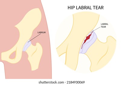 Hip Bone Pain Range Of Motion Groin Head Tear Treat Joint Thigh Femur Injury Spurs Socket Lesion