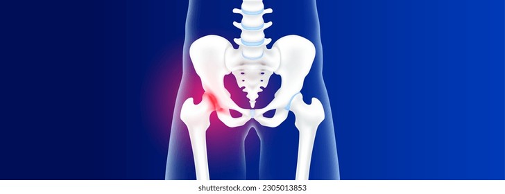 Hip bone, pelvis healthy and degenerative joint disease. Arthritis hip pain cartilage becomes worn. This results in inflammation swelling. Human skeleton with copy space for text. Realistic 3d vector.