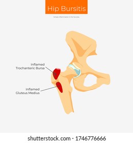Hip Bursitis. Inflammation in the hip area. Anatomy poster
