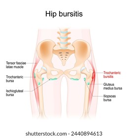 Hip bursitis. Muscles, Synovial bursas and bones of a human hip. Trochanteric bursitis. Realistic vector illustration