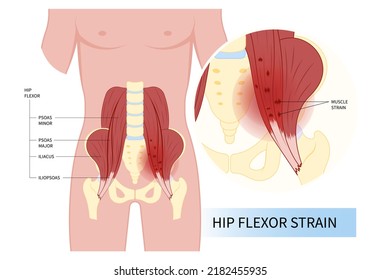 Hip Coxa Saltans Flexor Stretch Pain Rectus Bursae Intra Groin Broken Strain Iliacus Psoas Torn Major Band Joint Tear Thigh Tract Labral Tensor Femur Tendon Injury Muscle Greater Trauma Labrum