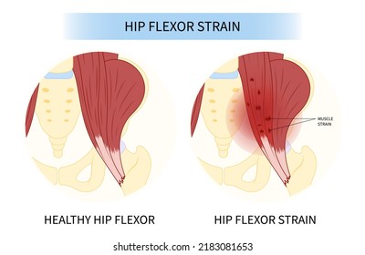 Hip Coxa Saltans Flexor Stretch Pain Rectus Bursae Intra Groin Broken Strain Iliacus Psoas Torn Major Band Joint Tear Thigh Tract Labral Tensor Femur Tendon Injury Muscle Greater Trauma Labrum