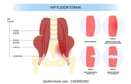 Hip Coxa Saltans Flexor Stretch Pain Rectus Bursae Intra Groin Broken Strain Iliacus Psoas Torn Major Band Joint Tear Thigh Tract Labral Tensor Femur Tendon Injury Muscle Greater Trauma Labrum