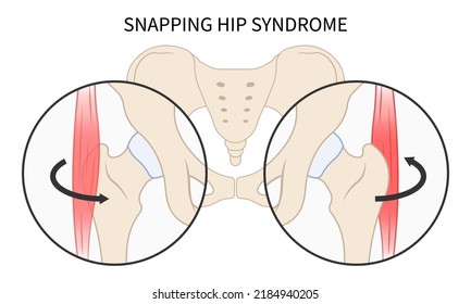 Hip Coxa Saltans Flexor Stretch Pain Rectus Bursae Intra Groin Broken Strain Iliacus Psoas Torn Major Band Joint Tear Thigh Tract Labral Tensor Femur Tendon Injury Muscle Greater Trauma Labrum