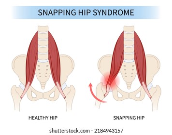 Hip Coxa Saltans Flexor Stretch Pain Rectus Bursae Intra Groin Broken Strain Iliacus Psoas Torn Major Band Joint Tear Thigh Tract Labral Tensor Femur Tendon Injury Muscle Greater Trauma Labrum