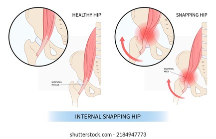 Hip Coxa Saltans Flexor Stretch Pain Rectus Bursae Intra Groin Broken Strain Iliacus Psoas Torn Major Band Joint Tear Thigh Tract Labral Tensor Femur Tendon Injury Muscle Greater Trauma Labrum