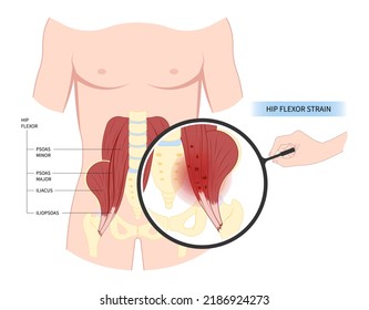 Hip Coxa Saltans Flexor Stretch Pain Rectus Bursae Intra Groin Broken Strain Iliacus Psoas Torn Major Band Joint Tear Thigh Tract Labral Tensor Femur Tendon Injury Muscle Greater Trauma Labrum