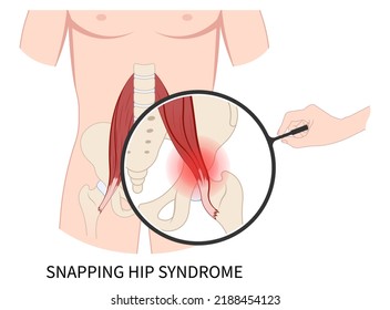 Hip Coxa Saltans Flexor Stretch Pain Rectus Bursae Intra Groin Broken Strain Iliacus Psoas Torn Major Band Joint Tear Thigh Tract Labral Tensor Femur Tendon Injury Muscle Greater Trauma Labrum