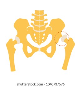 Hip dysplasia, flat design. Vector illustration, Isolated on white background.
