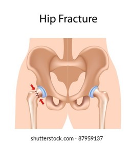 Hip Fracture