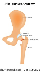 Hip Fracture Anatomy Science Design Illustration Diagram