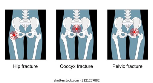 hip fracture, break of the sacrum or pelvis, pain in the coccyx. front view. Set icons. black and white. Flat vector illustration.