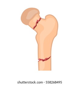 Hip Fracture Icon. Osteoporosis Bone. Vector Illustration Flat Design.