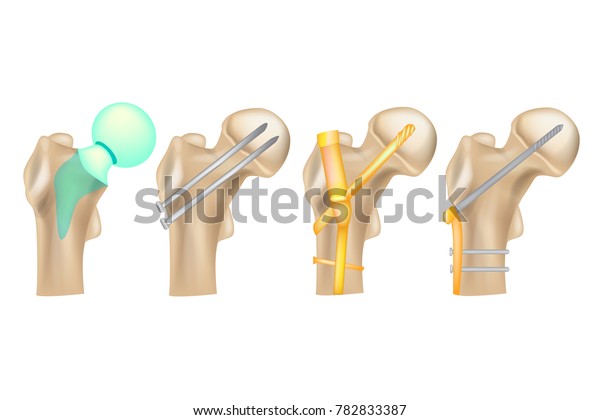 Hip Fracture Illustration Showing Variety Hip Stock Vector (Royalty ...