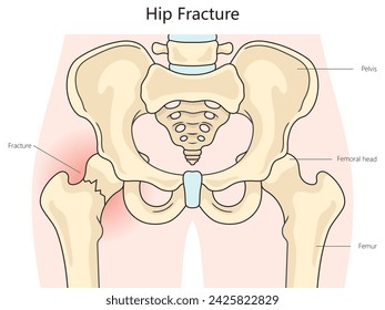 Hip fracture structure diagram hand drawn schematic vector illustration. Medical science educational illustration