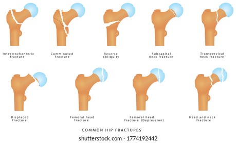 Hip Fractures. Fractures Of The Proximal Femur. Types Of Femoral Neck Fracture. Garden Classification Of Hip Fractures. Femoral Neck Fractures Medical Illustration On White Background