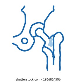 Hip Implante Sustitución de Implante Biomaterial vector de icono. Dibujo de la línea de doodle azul dibujado a mano ilustración de símbolo aislado