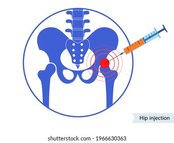 Hip joint cortisone injection. Pain and inflammation in the pelvis. Pelvic arthritis disease concept. Medical research in health care center. Bursitis treatment flat vector illustration for clinic.