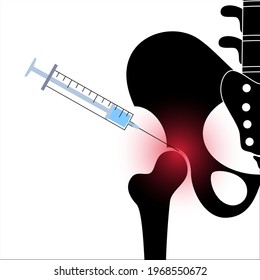 Hip joint cortisone injection. Pain and inflammation in the pelvis. Pelvic arthritis disease concept. Medical research in health care center. Bursitis treatment flat vector illustration for clinic.