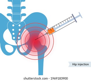 Inyección de cortisona en las articulaciones de la cadera. Dolor e inflamación en la pelvis. Concepto de artritis pélvica. Investigación médica en centros de salud. Bursitis tratamiento de ilustración vectorial plana para clínica.