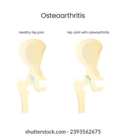 Hip Joint Healthy and Hip Joint Osteoarthritis Disease