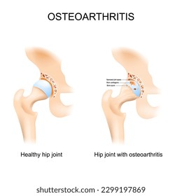 Hip joint with osteoarthritis with femoral head and the acetabulum of the pelvis. A comparison between a healthy hip joint and one with osteoarthritis, highlighting the key differences in structure.