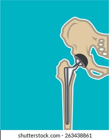 Hip Joint Replacement