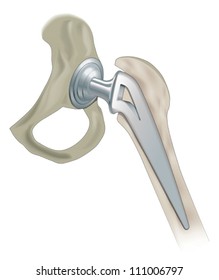 Hip Joint Replacement, Artificial Joint