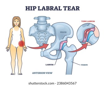 Hip labral tear anatomical explanation with medical labrum bone damage outline diagram. Labeled educational skeletal anatomy with pelvis, femur and torn labrum condition example vector illustration.