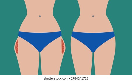 Hip liposuction, hip correction before and after. Exercises for local fat removal. Vector illustration