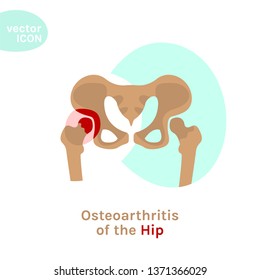 Hip Osteoarthritis Icon. Flat Style. Lower Back And Joint Pain. Editable Vector Illustration Isolated On A White Background. Medical, Healthcare, Elderly Diseases Graphic Concept.