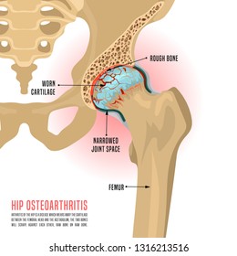 free clinical trials for osteoarthritis of the hip