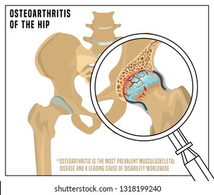 Hip Osteoarthritis Infographic. Realistic bones scheme. Lower back and joint pain. Editable vector illustration isolated on a light background. Medical, healthcare, elderly diseases graphic concept.