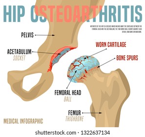 Hip Osteoarthritis Infographic. Realistic bones scheme. Lower back and joint pain. Editable vector illustration isolated on a light background. Medical, healthcare, elderly diseases graphic concept.