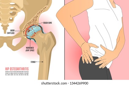 Hip Osteoarthritis Infographic. Realistic bones scheme. Lower back and joint pain. Editable vector illustration isolated on a light background. Medical, healthcare, elderly diseases graphic concept.