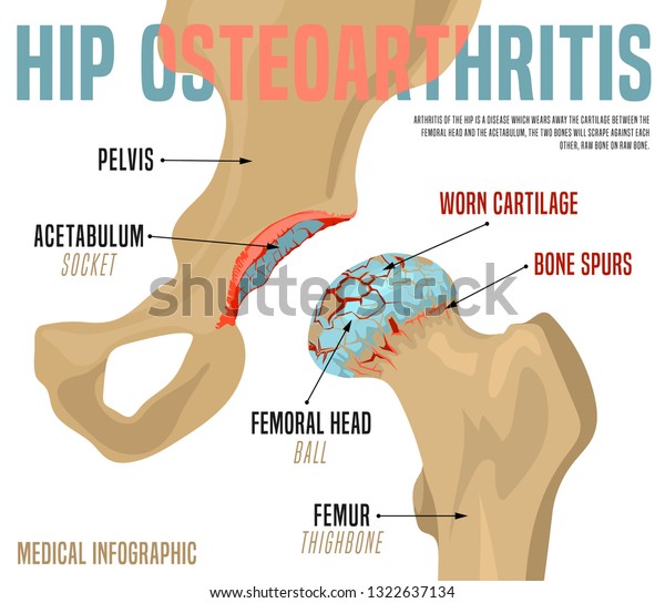 Hip Osteoarthritis Infographic Realistic Bones Scheme庫存向量圖 免版稅 1322637134