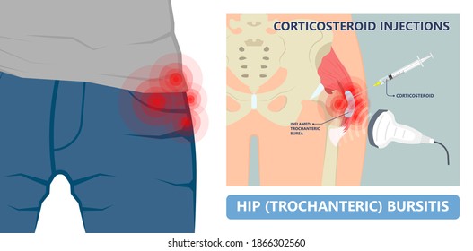 Hip pain knee heel cuff bone gout drug Feet bursa joint elbow treat tear drain shots fluid Ankle bursae tendon muscle trauma injury septic frozen tennis therapy rotator disease greater relieve swollen
