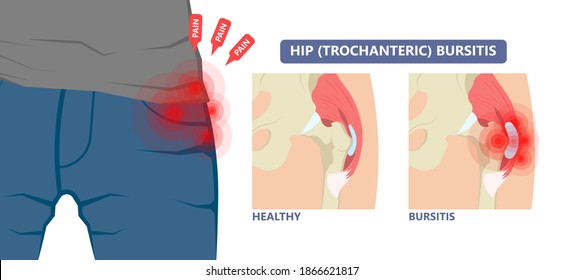 síntomas de fractura de cadera que causan la enfermedad de la osteoporosis