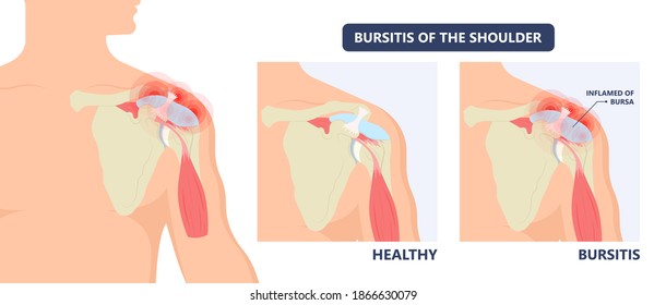 Hip pain knee heel cuff bone gout drug Feet bursa joint elbow treat tear drain shots fluid Ankle bursae tendon muscle trauma injury septic frozen tennis therapy rotator disease greater relieve swollen