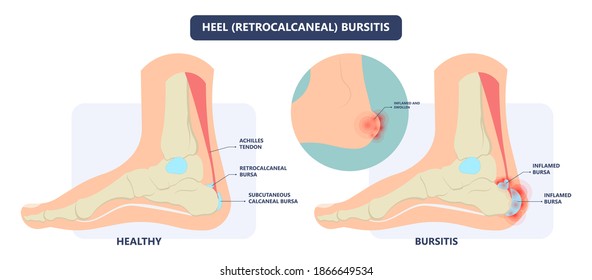 Hip pain knee heel cuff bone gout drug Feet bursa joint elbow treat tear drain shots fluid Ankle bursae tendon muscle trauma injury septic frozen tennis therapy rotator disease greater relieve swollen