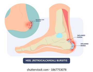 Hip pain knee heel cuff bone gout drug Feet bursa joint elbow treat tear drain shots fluid Ankle bursae tendon muscle trauma injury septic frozen tennis therapy rotator disease greater relieve swollen