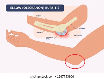 Hip pain knee heel cuff bone gout drug Feet bursa joint elbow treat tear drain shots fluid Ankle bursae tendon muscle trauma injury septic frozen tennis therapy rotator disease greater relieve swollen