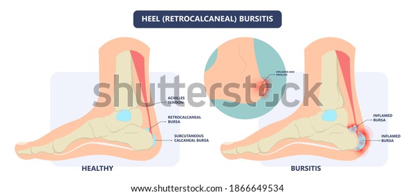 Hip Pain Knee Heel Cuff Bone Stock Vector (Royalty Free) 1866649534