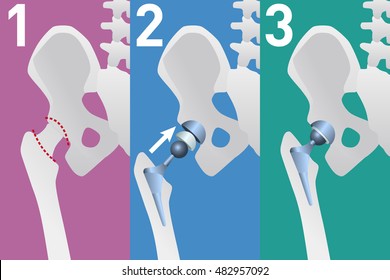 Hip Replacement Arthroplasty Diagram, Vector Illustration