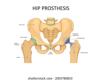 Hip replacement implant installed in the pelvis bone. Medical vector illustration