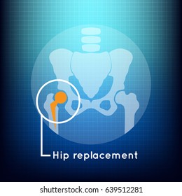 Hip Replacement Logo Vector Icon Design