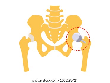 Hip replacement partly half. Vector illustration. Isolated on white background