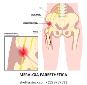 Hip sciatica bursitis pain Leg Injury and IT Band Syndrome or Meralgia Paresthetica compressed spine tingling numbness thigh pinched nerve