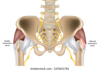 Hip Trochanteric bursitis is inflammation of the bursa. Illustration of the  Healthy and inflamed trochanteric bursa. Greater trochanteric pain syndrome. 