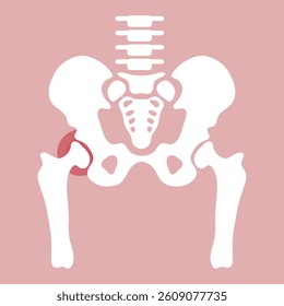 Hips Arthritis flat illustrations vector